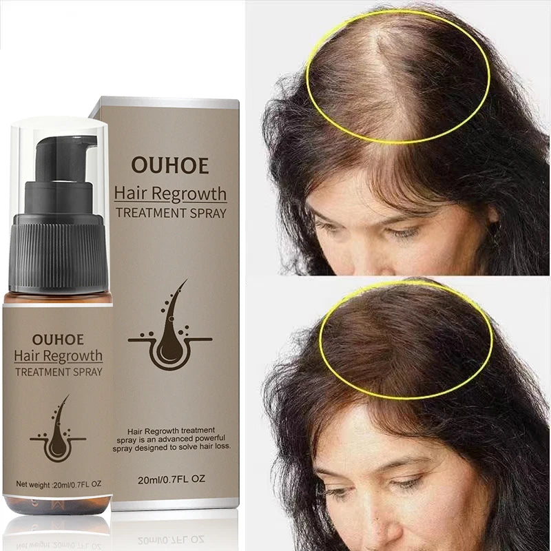 Fast Hair Growth Spray Products anti Hair Loss Serum Prevent Baldness Treatment Scalp Dry Damaged Essential Oil Hair Beauty